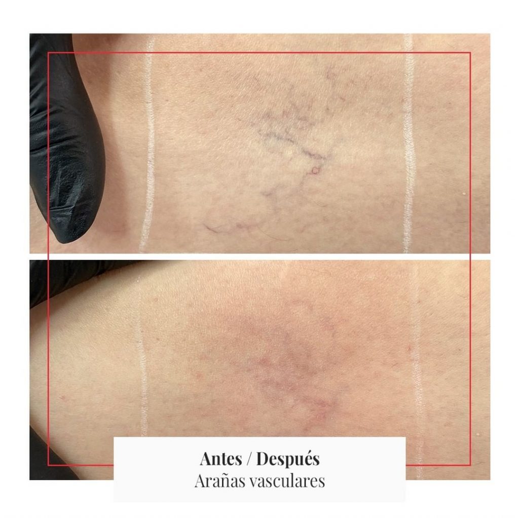 Eliminar arañas vasculares