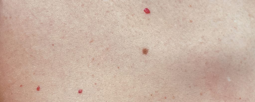 eliminar punto rubí