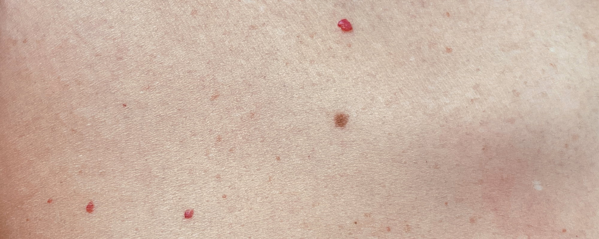 eliminar punto rubí