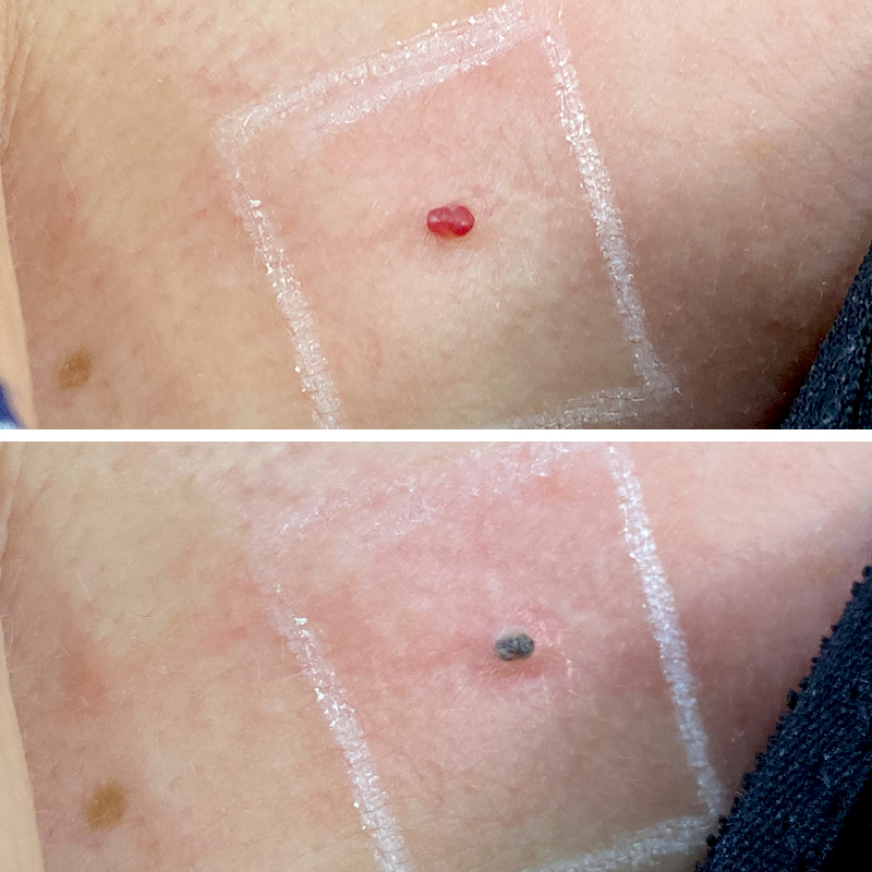 arañas vasculares zaragoza