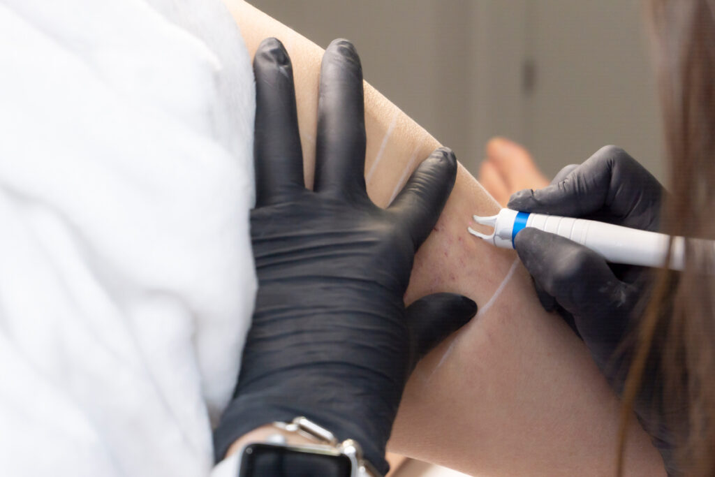 arañas vasculares hombres