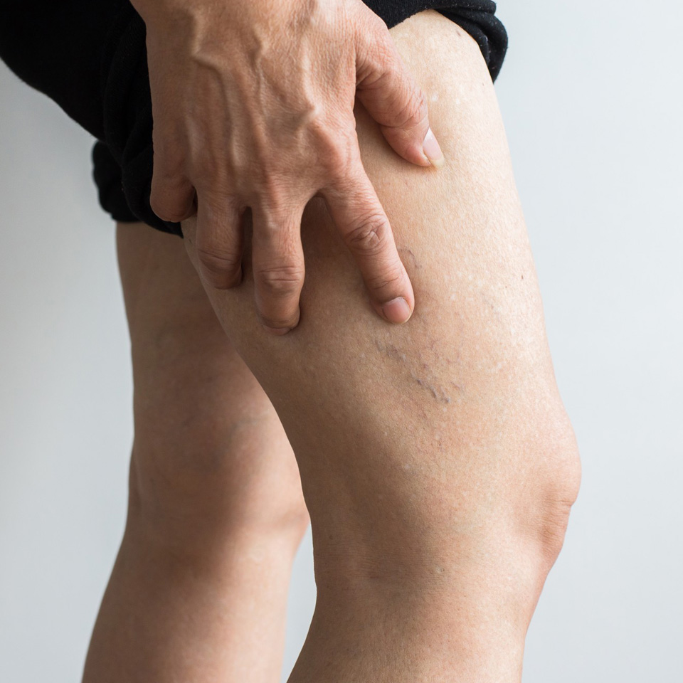 arañas vasculares zaragoza eliminar