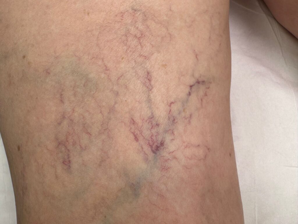 como evitar arañas vasculares