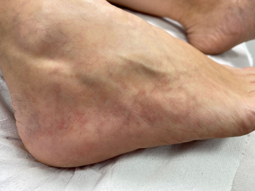 arañas vasculares eliminar cuando