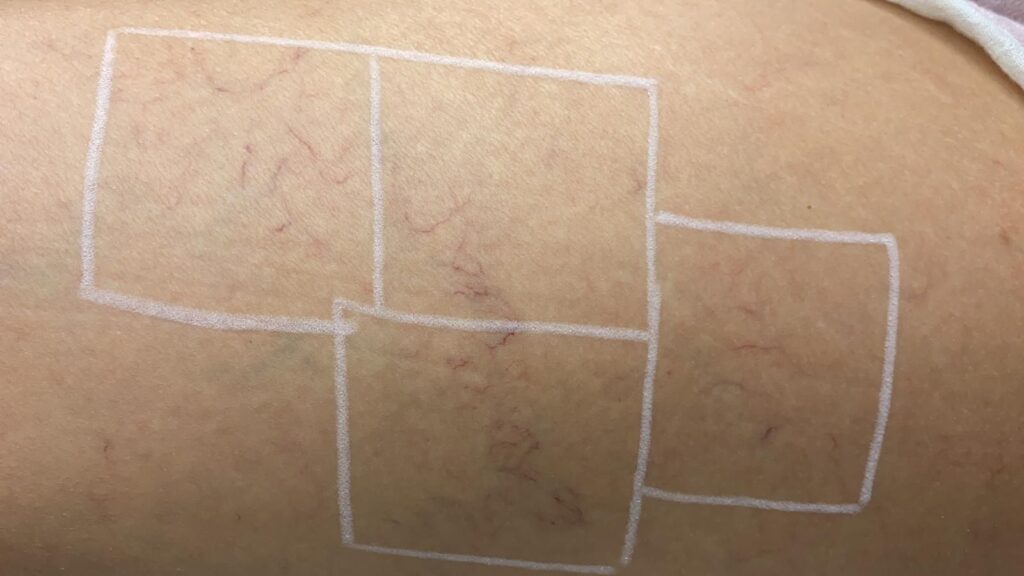 eliminar varices en zaragoza